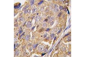 IHC analysis of FFPE human breast carcinoma tissue stained with EIF4B antibody (EIF4B antibody  (AA 400-429))