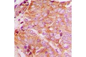 Immunohistochemical analysis of YTHDF1 staining in human breast cancer formalin fixed paraffin embedded tissue section. (YTHDF1 antibody  (N-Term))