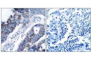 Immunohistochemical analysis of paraffin- embedded human breast carcinoma tissue, using ASK1 (Ab-83) antibody (E021125). (ASK1 antibody)