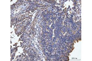 IHC analysis of MUC1 using anti-MUC1 antibody (ABIN7602711). (MUC1 antibody  (AA 979-1095))