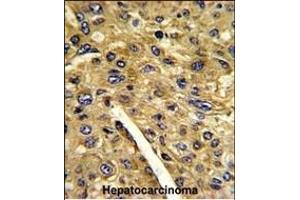 Formalin-fixed and paraffin-embedded human hepatocarcinoma reacted with T Antibody (N-term), which was peroxidase-conjugated to the secondary antibody, followed by DAB staining. (Aminomethyltransferase antibody  (N-Term))