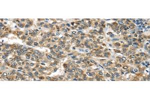 Immunohistochemistry of paraffin-embedded Human liver cancer tissue using TNFAIP2 Polyclonal Antibody at dilution 1:40 (TNFAIP2 antibody)