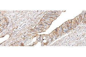 Immunohistochemistry of paraffin-embedded Human colorectal cancer tissue using BLVRB Polyclonal Antibody at dilution of 1:65(x200) (BLVRB antibody)