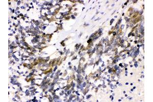 Anti- Cdk4 Picoband antibody, IHC(P) IHC(P): Human Lung Cancer Tissue (CDK4 antibody  (AA 201-303))