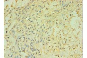 Immunohistochemistry of paraffin-embedded human breast cancer using ABIN7146501 at dilution of 1:100 (CALML5 antibody  (AA 1-146))