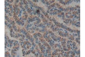 DAB staining on IHC-P; Samples: Human Thyroid cancer Tissue (Biglycan antibody  (AA 48-158))
