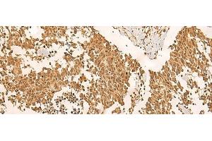 Immunohistochemistry of paraffin-embedded Human lung cancer tissue using EFTUD2 Polyclonal Antibody at dilution of 1:45(x200) (EFTUD2 antibody)