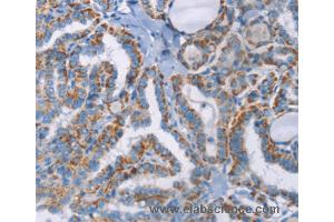 Immunohistochemistry of Human thyroid cancer using GPA33 Polyclonal Antibody at dilution of 1:30 (GPA33 antibody)