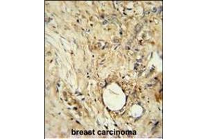 ITIH5 Antibody (C-term) (ABIN654918 and ABIN2844563) immunohistochemistry analysis in formalin fixed and paraffin embedded human breast carcinoma followed by peroxidase conjugation of the secondary antibody and DAB staining.