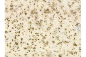 ABIN6264449 and ABIN6273150 at 1/100 staining human melanoma by IHC-P. (PRPF8 antibody  (C-Term))