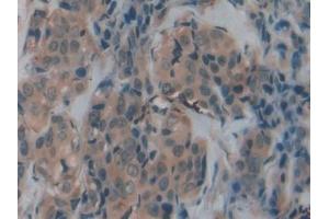Detection of TFR2 in Human Breast cancer Tissue using Polyclonal Antibody to Transferrin Receptor 2 (TFR2) (Transferrin Receptor 2 antibody  (AA 211-405))