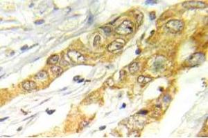 Immunohistochemistry (IHC) analyzes of ERK1/2 antibody in paraffin-embedded human breast carcinoma tissue. (ERK1/2 antibody)
