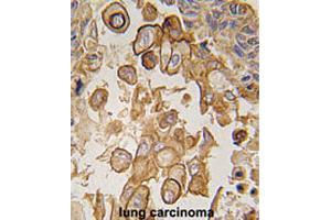 Formalin-fixed and paraffin-embedded human lung carcinomareacted with Tlr6 polyclonal antibody , which was peroxidase-conjugated to the secondary antibody, followed by AEC staining. (TLR6 antibody  (C-Term))