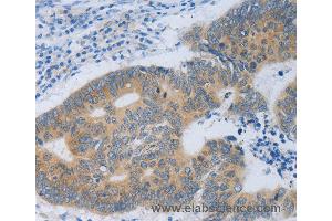 Immunohistochemistry of Human colon cancer using MT2A Polyclonal Antibody at dilution of 1:40