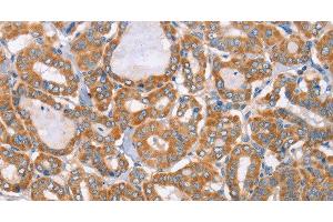 Immunohistochemistry of paraffin-embedded Human thyroid cancer tissue using MTMR7 Polyclonal Antibody at dilution 1:40 (MTMR7 antibody)