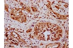 IHC image of ABIN7171075 diluted at 1:500 and staining in paraffin-embedded human cervical cancer performed on a Leica BondTM system. (SMARCD2 antibody  (AA 1-113))