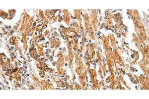 Immunohistochemistry of paraffin-embedded Human gastric cancer tissue using TGF β Receptor I Polyclonal Antibody at dilution 1:60 (TGFBR1 antibody)