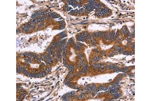 Immunohistochemical analysis of paraffin-embedded Human colon cancer tissue using at dilution 1/30. (KIR2DL3 antibody  (Internal Region))