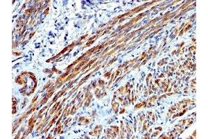 Formalin-fixed, paraffin-embedded human Leiomyosarcoma stained with SMMHC antibody (MYH11/923).