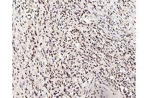 Immunohistochemistry analysis of paraffin-embedded human lung cancer using c-Fos Polyclonal Antibody at dilution of 1:200. (c-FOS antibody)