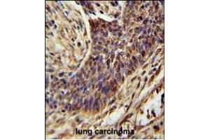 ZSWIM1 Antibody (C-term) (ABIN654558 and ABIN2844265) immunohistochemistry analysis in formalin fixed and paraffin embedded human lung carcinoma followed by peroxidase conjugation of the secondary antibody and DAB staining. (ZSWIM1 antibody  (C-Term))