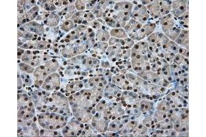 Immunohistochemical staining of paraffin-embedded Adenocarcinoma of colon tissue using anti-APP mouse monoclonal antibody. (APP antibody)