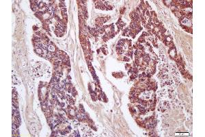 Formalin-fixed and paraffin embedded human colon carcinoma labeled with Anti-CD200/MOX1 Polyclonal Antibody, Unconjugated (ABIN761396) at 1:200 followed by conjugation to the secondary antibody and DAB staining