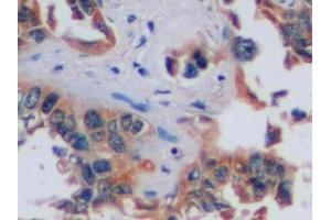 Detection of CA9 in Human Lung cancer Tissue using Polyclonal Antibody to Carbonic Anhydrase IX (CA9) (CA9 antibody  (AA 59-414))