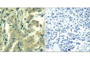 Immunohistochemical analysis of paraffin-embedded human lung carcinoma tissue using PLC-γ2 (Ab-1217) Antibody (E021524). (Phospholipase C gamma 2 antibody)