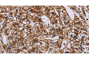 Immunohistochemistry of paraffin-embedded Human prostate cancer using BMP6 Polyclonal Antibody at dilution of 1:50 (BMP6 antibody)