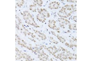 Immunohistochemistry of paraffin-embedded human colon carcinoma using SIRT1 antibody (ABIN6291361) at dilution of 1:100 (40x lens). (SIRT1 antibody)