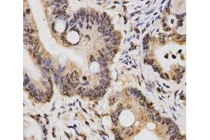 Immunohistochemistry of paraffin-embedded Human rectal cancer using DiMethyl-Histone H3-K14 Polyclonal Antibody at dilution of 1:200 (40x lens). (Histone 3 antibody  (2meLys14))