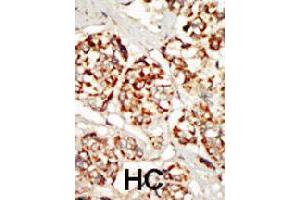Formalin-fixed and paraffin-embedded human hepatocellular carcinoma tissue reacted with KSR1 polyclonal antibody  , which was peroxidase-conjugated to the secondary antibody, followed by DAB staining. (KSR1 antibody  (N-Term))