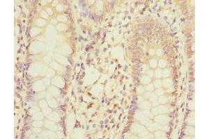 Immunohistochemistry of paraffin-embedded human colon cancer using ABIN7158982 at dilution of 1:100 (MPI antibody  (AA 1-423))