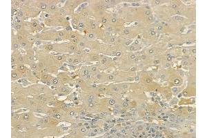 ABIN6262599 and ABIN6273256 at 1/100 staining human pancreatic carcinoma by IHC-P.
