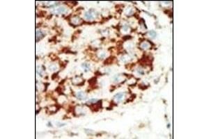 Formalin-fixed and paraffin-embedded human cancer tissue reacted with the primary antibody, which was peroxidase-conjugated to the secondary antibody, followed by AEC staining. (PRKAB1 antibody  (N-Term))