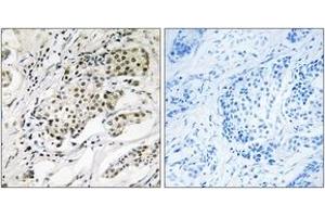 Immunohistochemistry analysis of paraffin-embedded human breast carcinoma, using CDYL2 Antibody. (CDYL2 antibody  (AA 31-80))