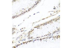 Immunohistochemistry of paraffin-embedded human colon carcinoma using HIRA antibody (ABIN6128018, ABIN6141776, ABIN6141778 and ABIN6224528) at dilution of 1:100 (40x lens). (HIRA antibody  (AA 250-550))