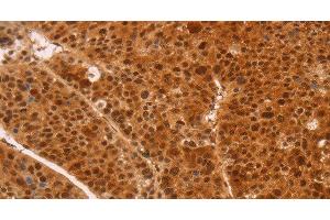 Immunohistochemistry of paraffin-embedded Human liver cancer tissue using HEXIM1 Polyclonal Antibody at dilution 1:65 (HEXIM1 antibody)