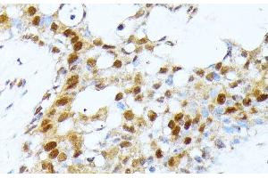 Immunohistochemistry of paraffin-embedded Human breast cancer using PRMT1 Polyclonal Antibody at dilution of 1:100 (40x lens). (PRMT1 antibody)