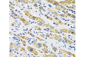 Immunohistochemistry of paraffin-embedded Human liver cancer using SLC16A4 Polyclonal Antibody at dilution of 1:100 (40x lens). (SLC16A4 antibody)