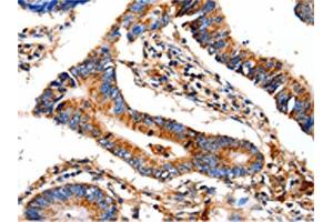 The image on the left is immunohistochemistry of paraffin-embedded Human colon cancer tissue using ABIN7129022(COX8A Antibody) at dilution 1/12, on the right is treated with fusion protein. (COX8A antibody)