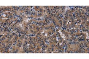 Immunohistochemistry of paraffin-embedded Human thyroid cancer using PDE4A Polyclonal Antibody at dilution of 1:40 (PDE4A antibody)