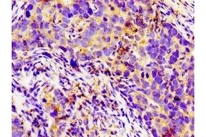 Immunohistochemistry of paraffin-embedded human pancreatic cancer using ABIN7158134 at dilution of 1:100 (LGR6 antibody  (AA 839-962))