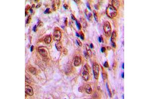 Immunohistochemical analysis of STAT4 (pY693) staining in human lung cancer formalin fixed paraffin embedded tissue section. (STAT4 antibody  (C-Term, pTyr693))