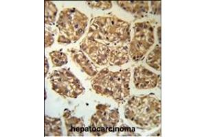 BLNK Antibody (Center) (R) IHC analysis in formalin fixed and paraffin embedded human hepatocarcinoma followed by peroxidase conjugation of the secondary antibody and DAB staining. (B-Cell Linker antibody  (AA 150-178))