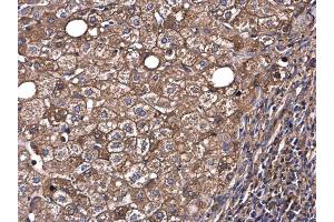 IHC-P Image Albumin antibody detects Albumin protein at cytoplasm in human hepatocellular carcinoma by immunohistochemical analysis. (Albumin antibody  (C-Term))