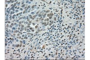 Immunohistochemical staining of paraffin-embedded Adenocarcinoma of colon tissue using anti-SATB1mouse monoclonal antibody. (SATB1 antibody)