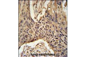 LPPR4 Antibody immunohistochemistry analysis in formalin fixed and paraffin embedded human lung carcinoma followed by peroxidase conjugation of the secondary antibody and DAB staining. (LPPR4 antibody  (C-Term))