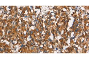 Immunohistochemistry of paraffin-embedded Human thyroid cancer tissue using CEACAM3 Polyclonal Antibody at dilution 1:30 (CEACAM3 antibody)